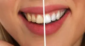 Comparison. Fluorosis Teeth vs. Normal