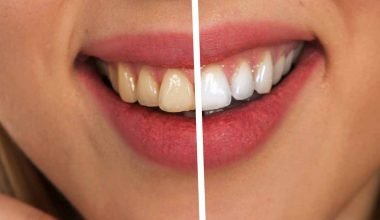 Comparison. Fluorosis Teeth vs. Normal