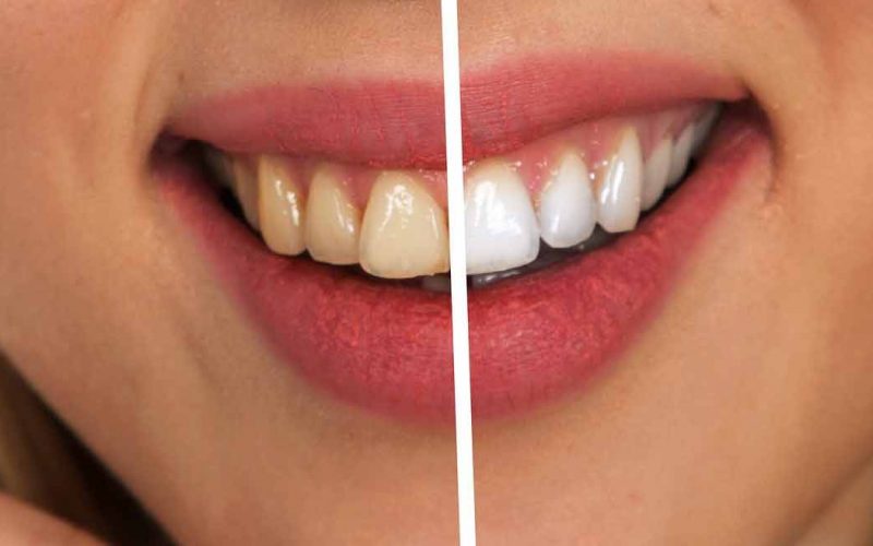 Comparison. Fluorosis Teeth vs. Normal