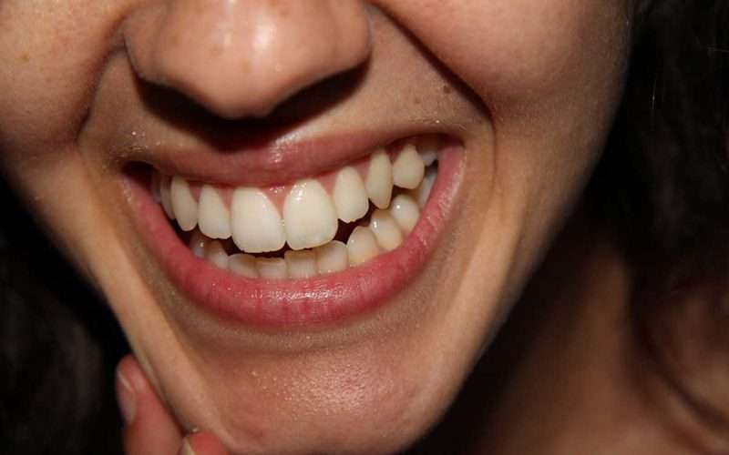 Smile-with-Natural-White-teeth